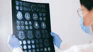 Pesquisa mostra que é possível monitorar a pressão intracraniana de pacientes com lesões cerebrais graves sem precisar de cirurgia aberta de crânio. - Foto: Canva Pro