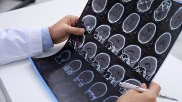 Muitos sinais da epilepsia infantil ainda passam despercebidos por familiares e até por profissionais de saúde. - Foto: Canva Pro
