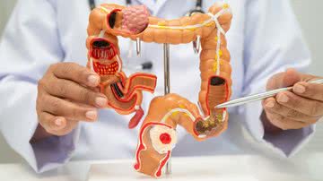 Nos últimos anos tem se constatado o aumento de Doenças Inflamatórias Intestinais (DII). - Foto: Canva Pro