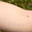 O molusco contagioso é uma infecção viral comum na infância. - Foto: Canva Pro