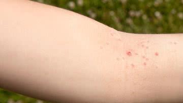 O molusco contagioso é uma infecção viral comum na infância. - Foto: Canva Pro
