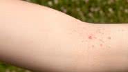 O molusco contagioso é uma infecção viral comum na infância. - Foto: Canva Pro