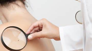 Médico faz exame com lupa nas costas de uma pinta de paciente