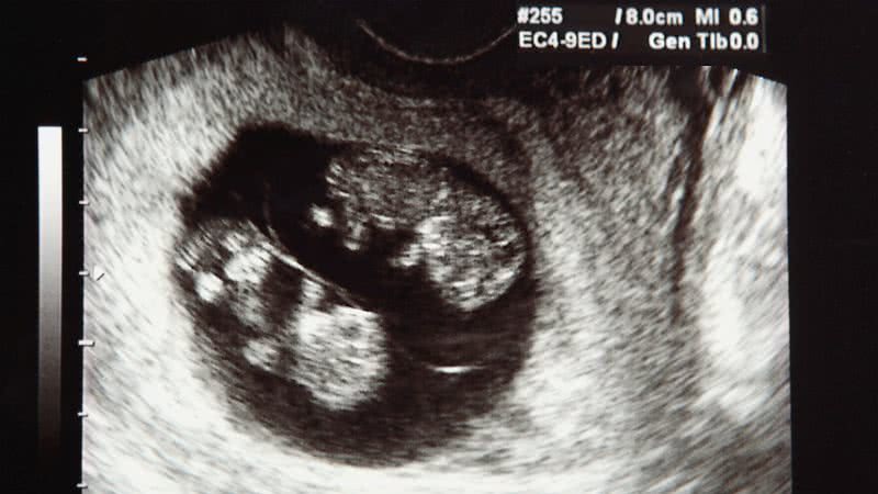 Gestações de gêmeos que compartilham a mesma placenta exigem cuidados redobrados - Foto: Canva Pro