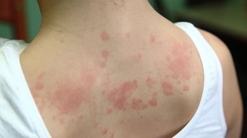 Pessoa com placas de urticária/ alergia nas costas
