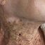 Foto que se espalhou pelas redes sociais nos últimos dias mostra a diferença da pele de uma senhora entre o rosto, onde usou protetor solar no rosto por muitos anos, e o pescoço. - Foto: JEADV (Journal of the European Academy of Dermatology and Venereology)