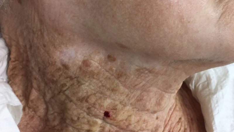 Foto que se espalhou pelas redes sociais nos últimos dias mostra a diferença da pele de uma senhora entre o rosto, onde usou protetor solar no rosto por muitos anos, e o pescoço. - Foto: JEADV (Journal of the European Academy of Dermatology and Venereology)