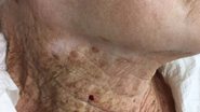 Foto que se espalhou pelas redes sociais nos últimos dias mostra a diferença da pele de uma senhora entre o rosto, onde usou protetor solar no rosto por muitos anos, e o pescoço. - Foto: JEADV (Journal of the European Academy of Dermatology and Venereology)