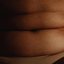 O lipedema pode atingir a barriga - pexels