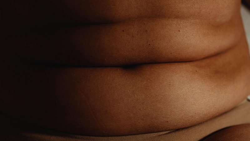O lipedema pode atingir a barriga - pexels