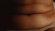 O lipedema pode atingir a barriga - pexels