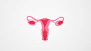 A endometriose pode aparecer em qualquer fase da idade reprodutiva e tem tratamento