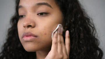 Tratamento de acne inclui higenização com sabonetes específicos, protetor solar, e a procura de um dermatologista.