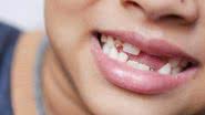 Dentes de leite precisam de cuidados