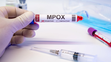 Entre 2022 e 2024, o Brasil registrou 12 mil casos confirmados de mpox - Canva